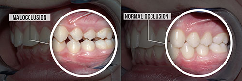 The image shows a series of two photographs side by side, with the left photo depicting a close-up view of a person s teeth and gums, while the right photo provides an interior perspective from within the mouth, focusing on the teeth and oral cavity.