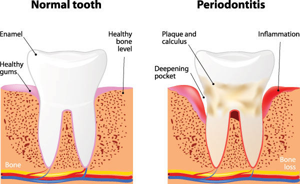 The image shows a diagrammatic representation of the stages of gum disease, from normal to advanced periodontitis, illustrating the progression of bone loss and inflammation around teeth.