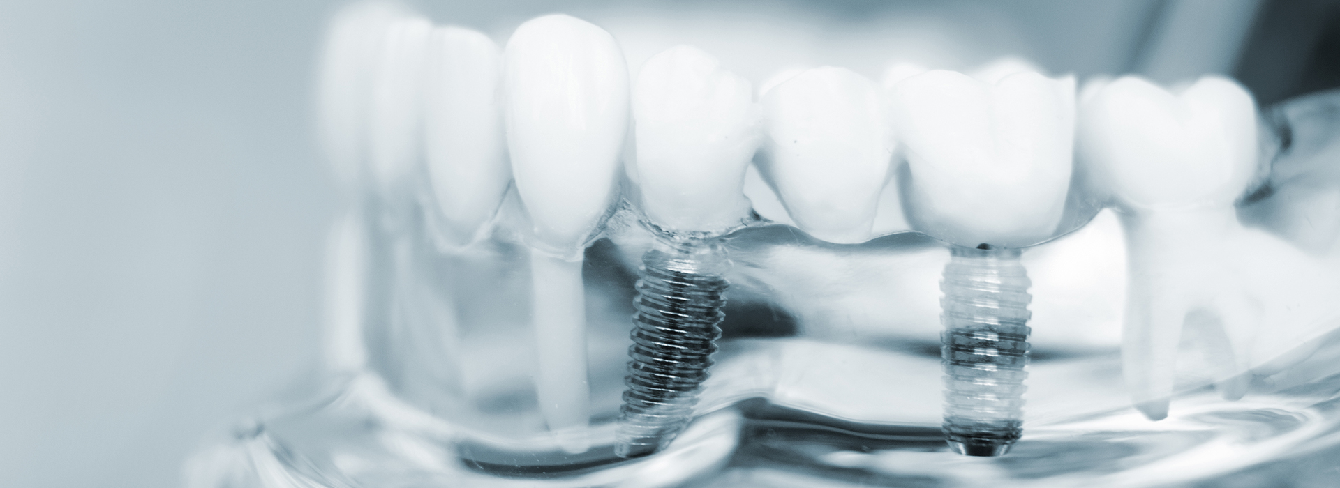 Close-up of a transparent dental implant with screws and abutments, showcasing its components for educational or promotional purposes.