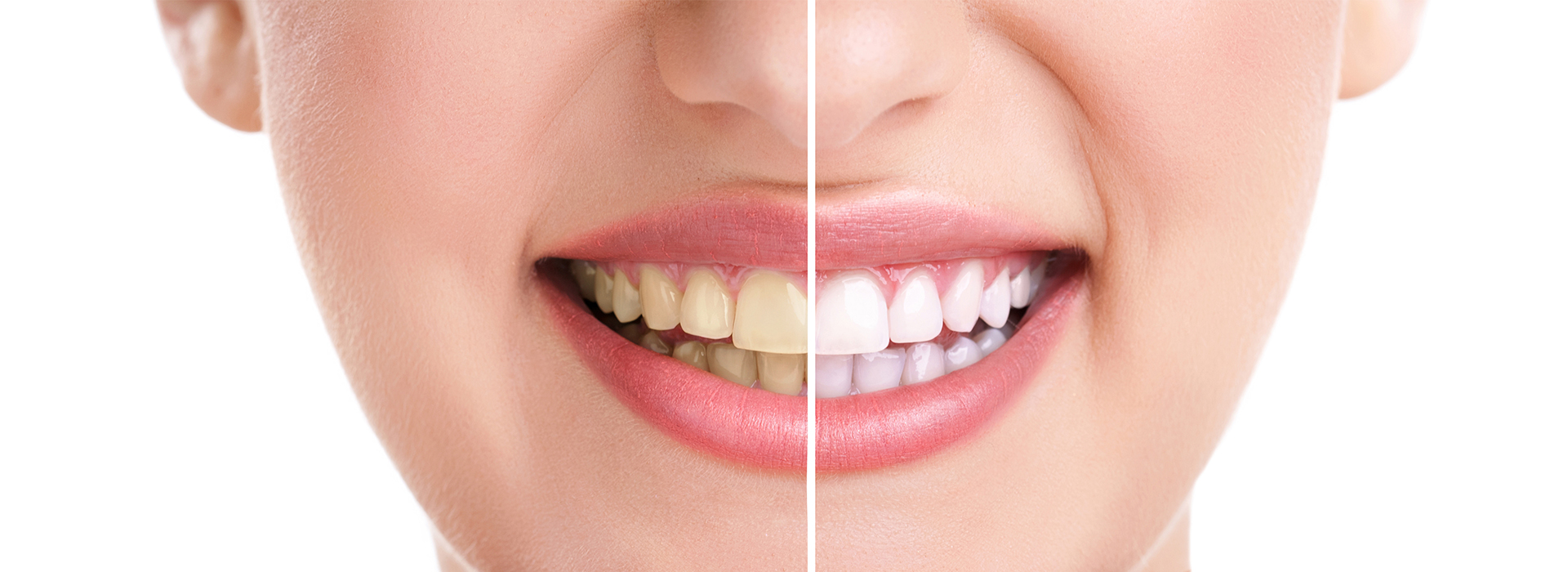 The image shows a close-up of a person s face with a focus on their teeth, illustrating the process of teeth whitening with a before and after comparison.